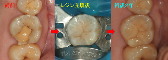 第一大臼歯 精密根管治療 症例②（下顎左側第一大臼歯 再根管治療